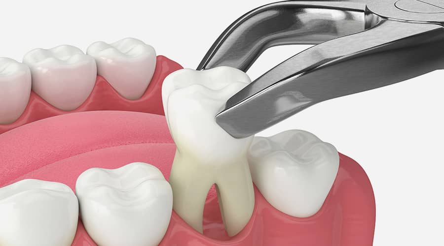 Dental Abscess