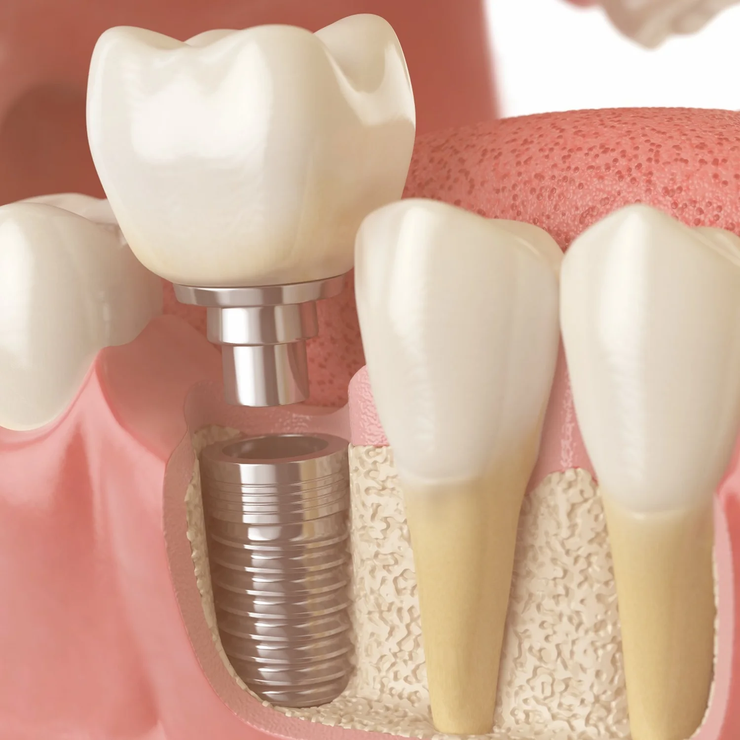 Bone Grafting at Bethesda Family Dental